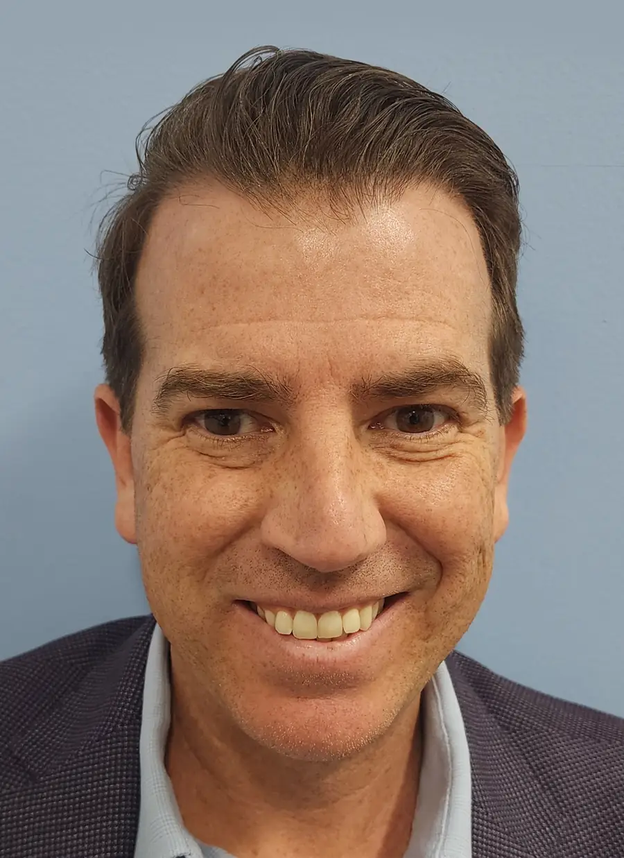 After hair transplant — 1,414 grafts · 46 y/o man