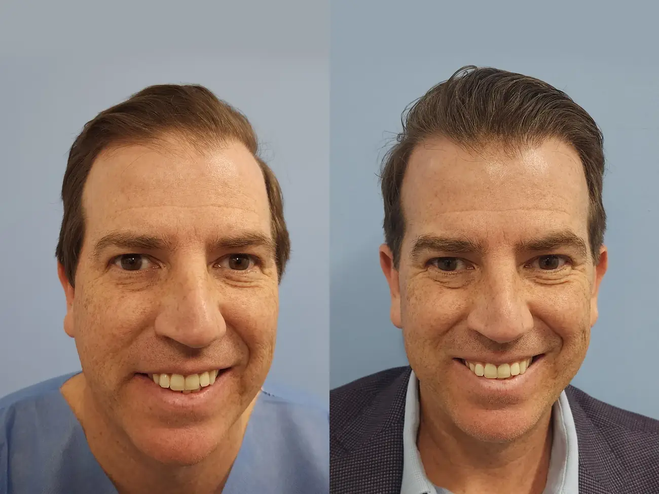 Front facial view before and after FUE — ARTAS iXi robotic, 1,414 grafts, 46 year old man