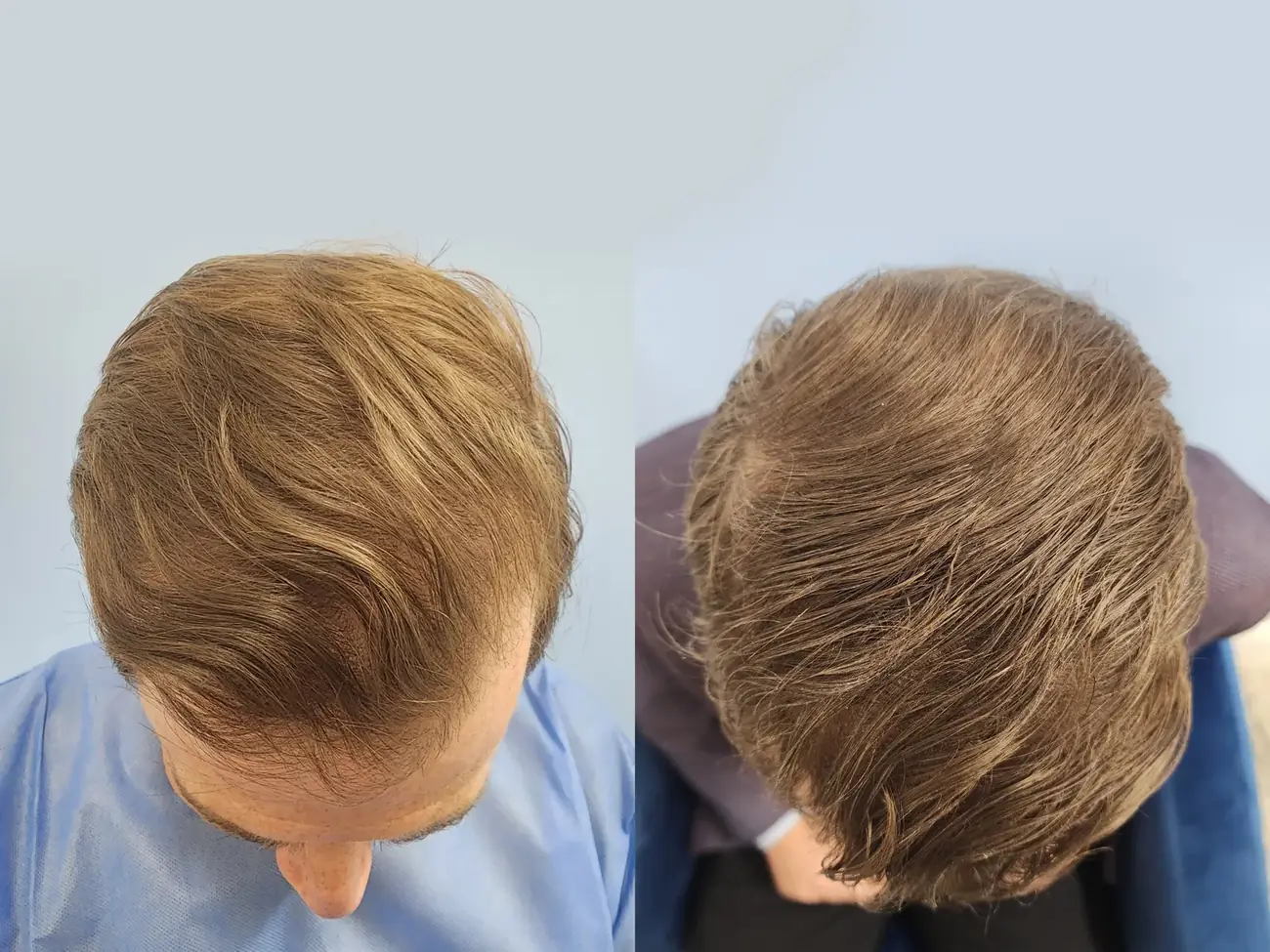 Chin to chest view before and after FUE — ARTAS iXi robotic, 1,414 grafts, 46 year old man