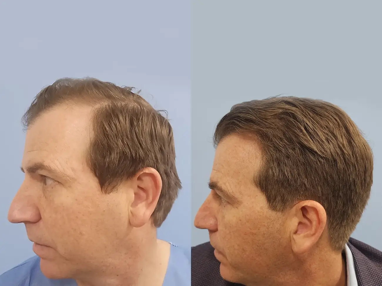Left oblique view before and after FUE — ARTAS iXi robotic, 1,414 grafts, 46 year old man