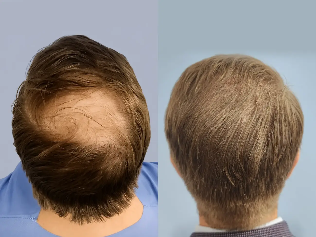 Vertex (crown) view before and after FUE — ARTAS iXi robotic, 1,414 grafts, 46 year old man