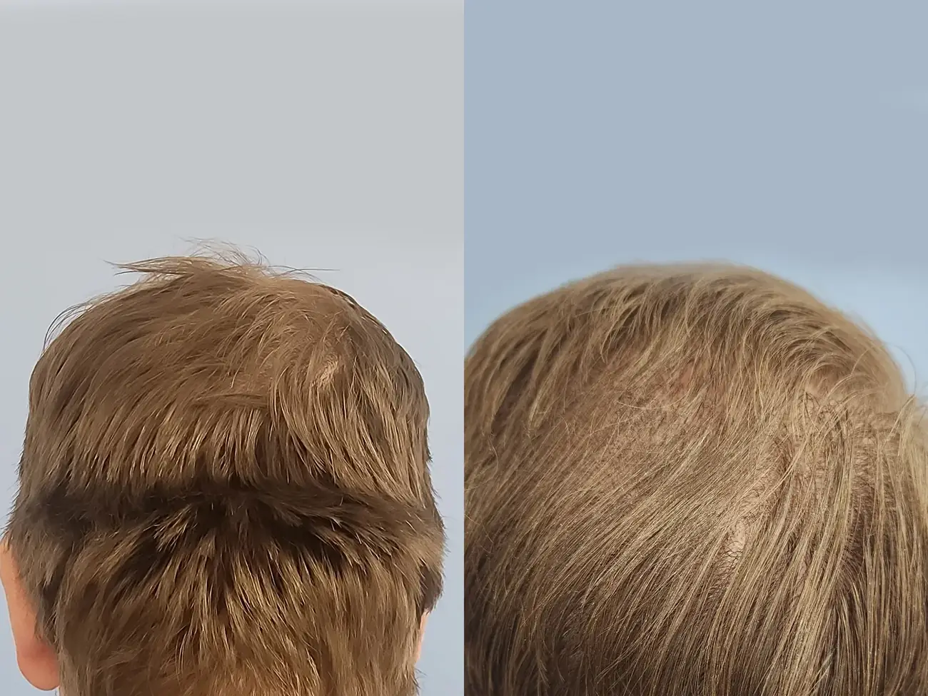 Donor area view before and after FUE — ARTAS iXi robotic, 1,414 grafts, 46 year old man