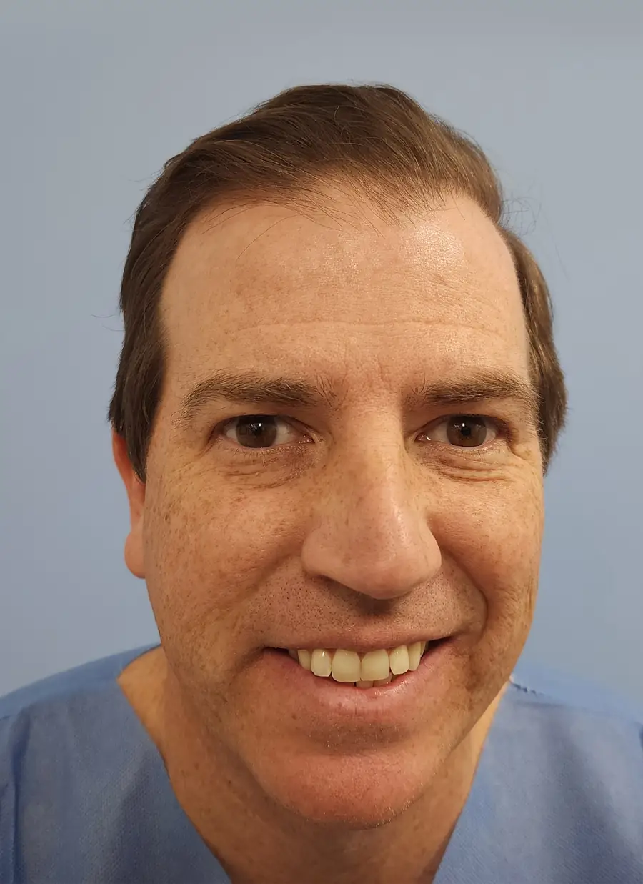 Before hair transplant — 1,414 grafts · 46 y/o man