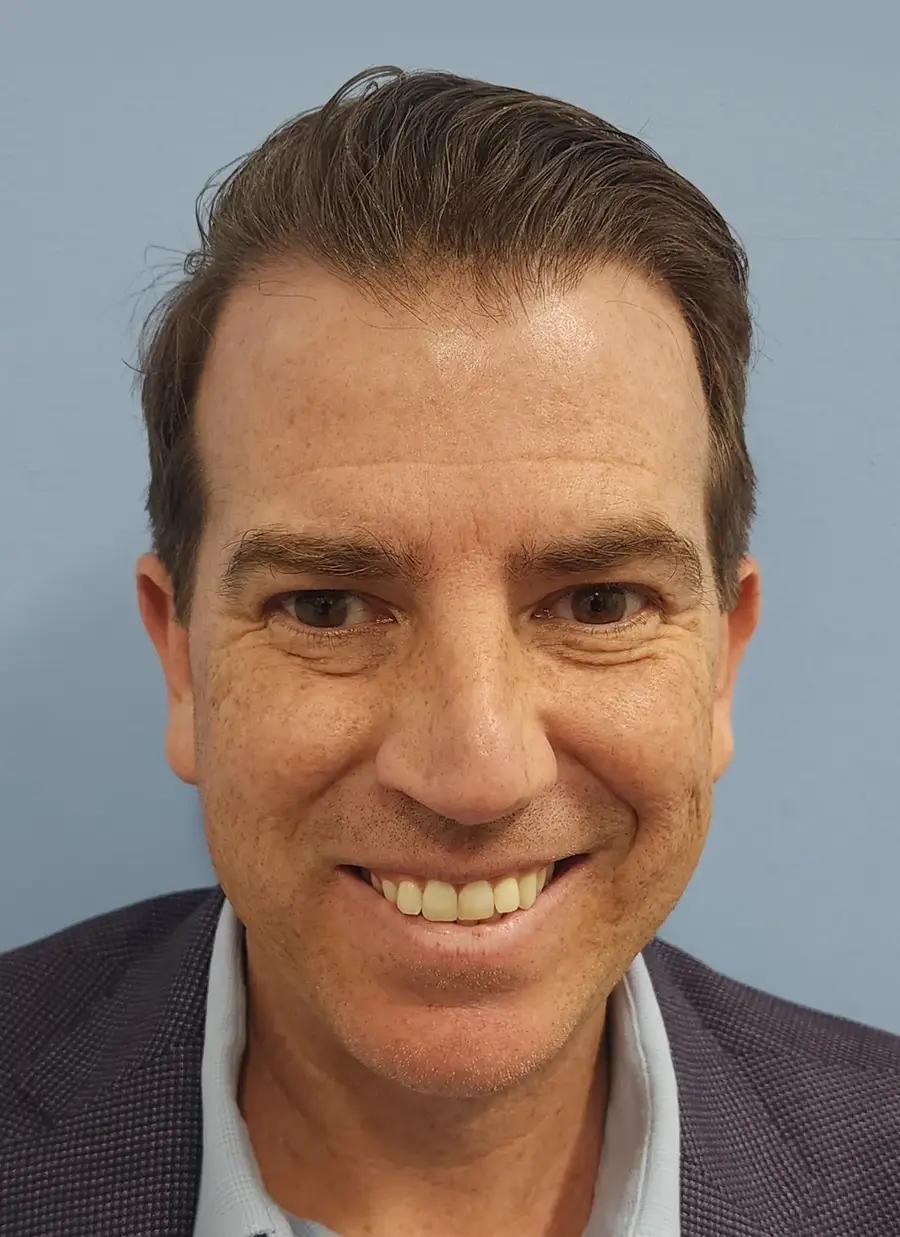 After ARTAS iXi Robotic FUE, 1,414 grafts