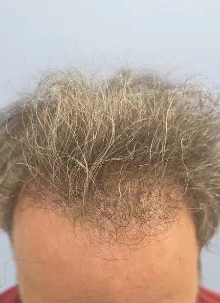 Robotic Hair Restoration of Manhattan