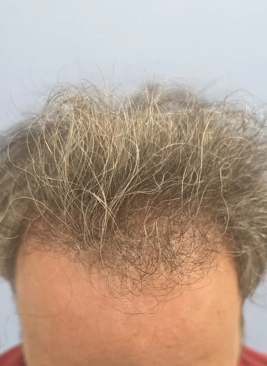 After FUT (strip), 3,381 grafts