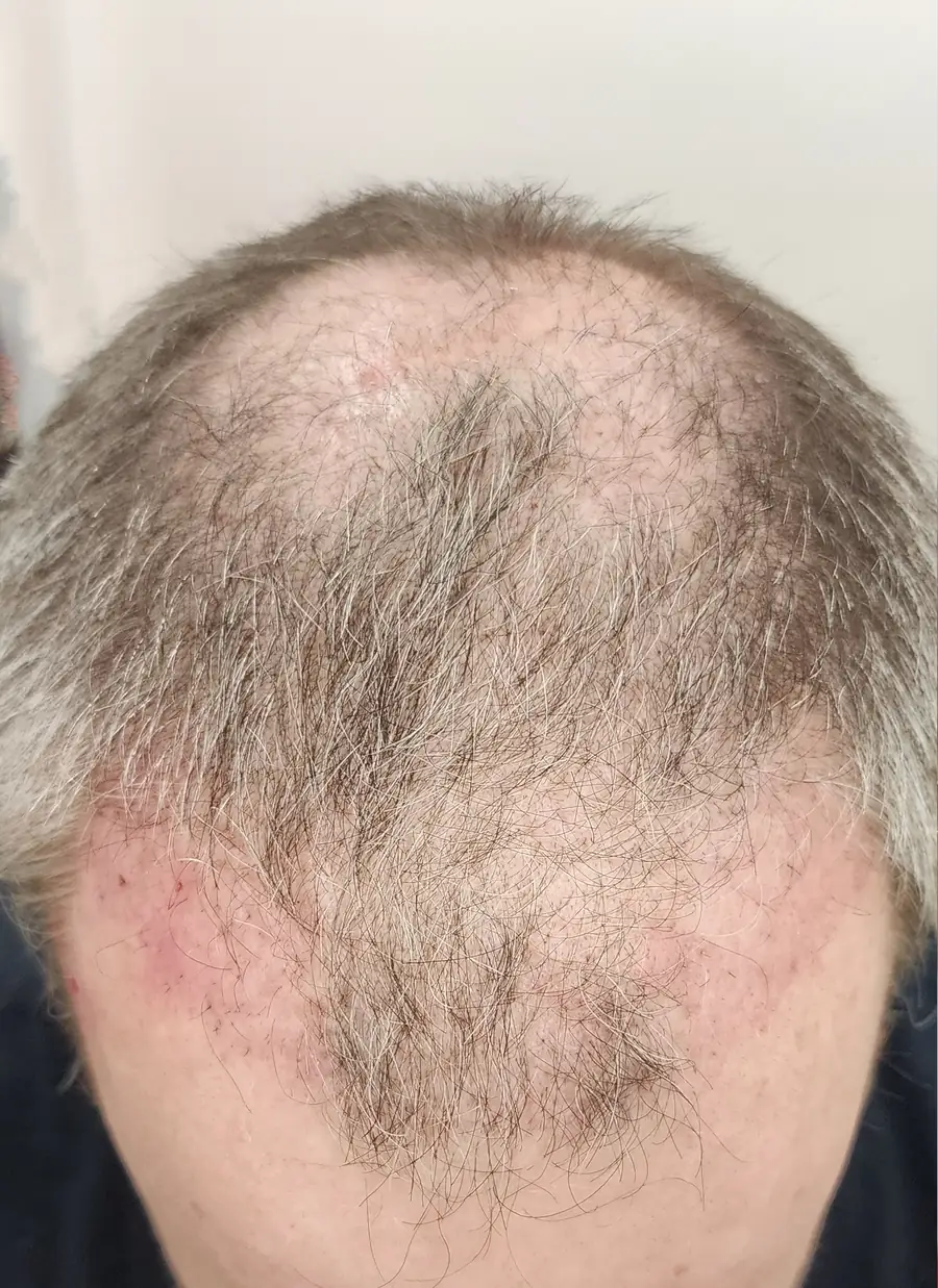Before FUT (strip), 3,381 grafts