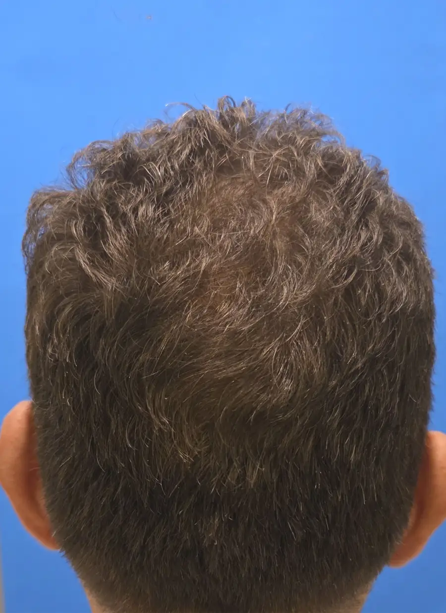 After hair transplant — 4,142 grafts · 59 y/o man