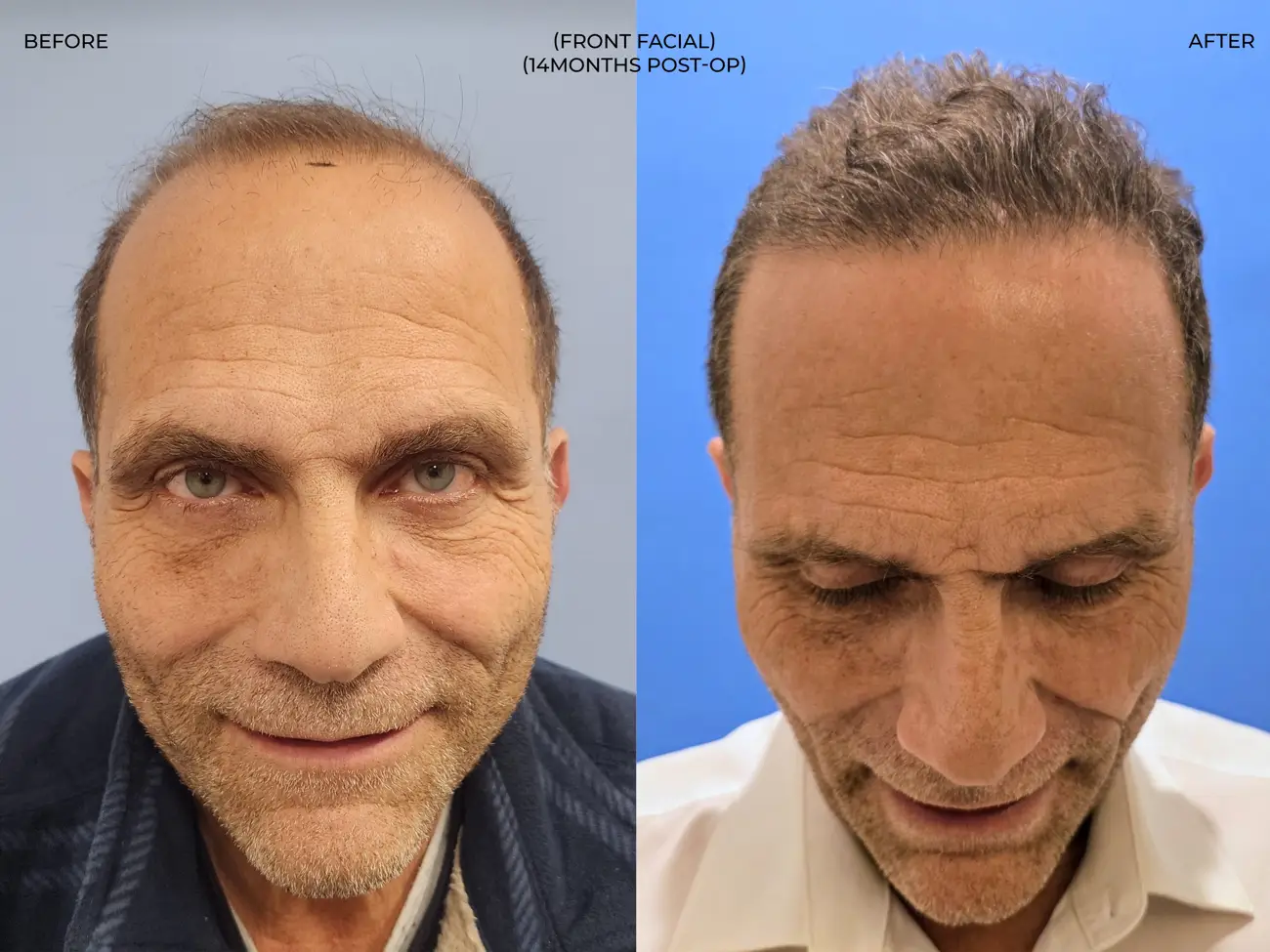 Front facial view before and after ARTAS iXi Robotic FUE + NeoGraft, 4,142 grafts, 59 year old man