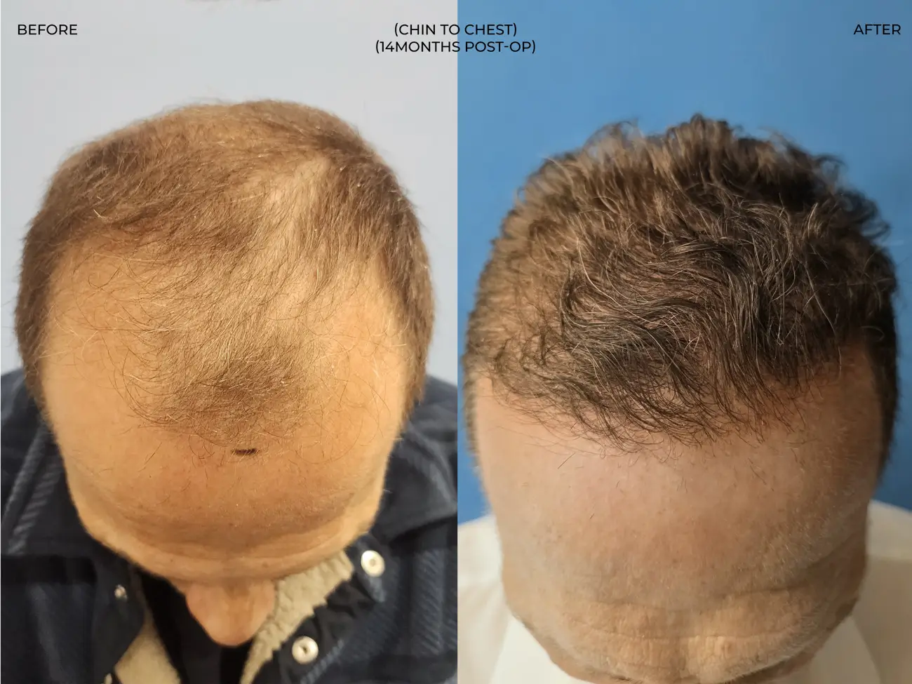 Chin to chest view before and after ARTAS iXi Robotic FUE + NeoGraft, 4,142 grafts, 59 year old man