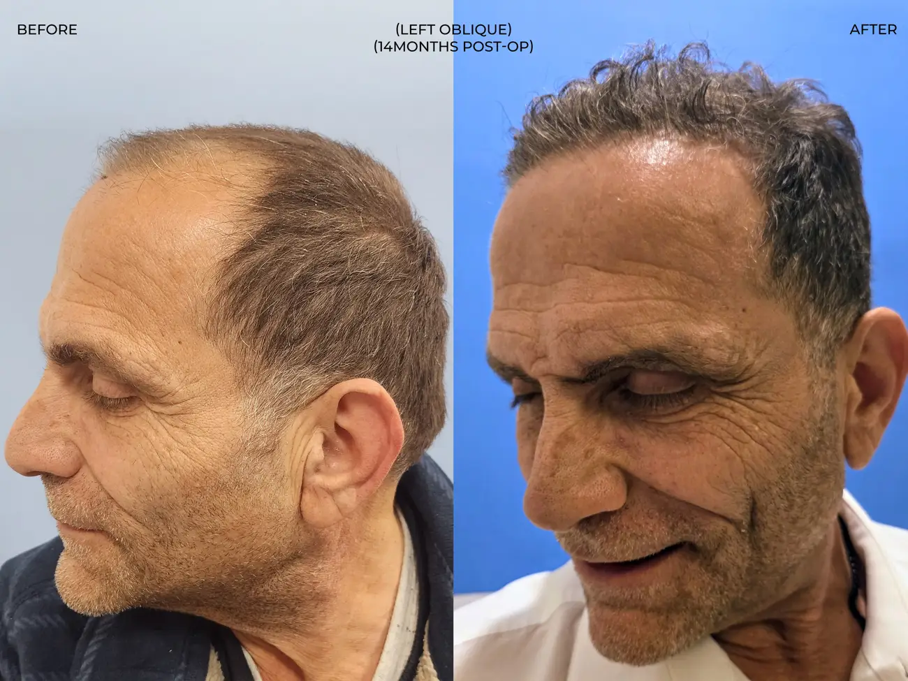 Left oblique view before and after ARTAS iXi Robotic FUE + NeoGraft, 4,142 grafts, 59 year old man