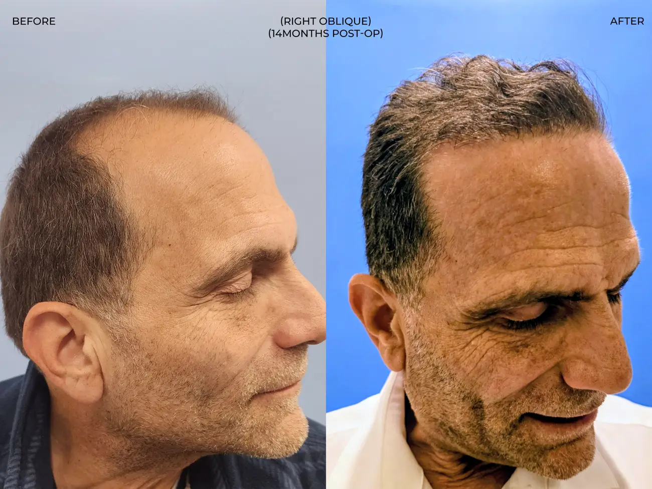 Right oblique view before and after ARTAS iXi Robotic FUE + NeoGraft, 4,142 grafts, 59 year old man