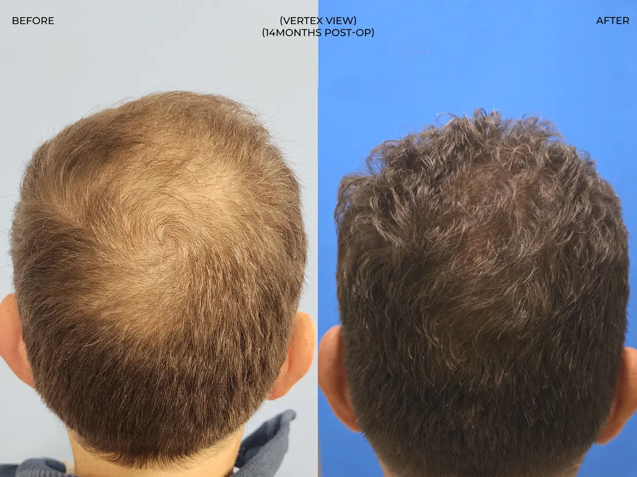 Vertex (crown) view before and after ARTAS iXi Robotic FUE + NeoGraft, 4,142 grafts, 59 year old man