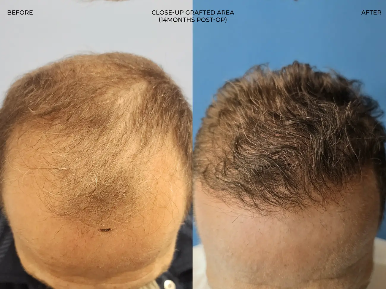 Close-up frontal view before and after ARTAS iXi Robotic FUE + NeoGraft, 4,142 grafts, 59 year old man