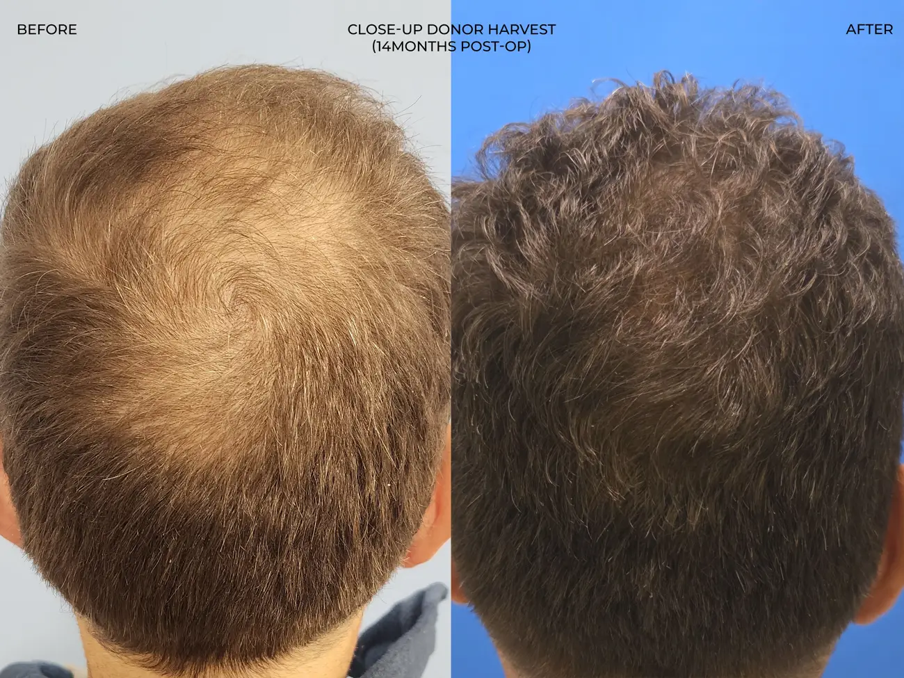 Vertex full view view before and after ARTAS iXi Robotic FUE + NeoGraft, 4,142 grafts, 59 year old man