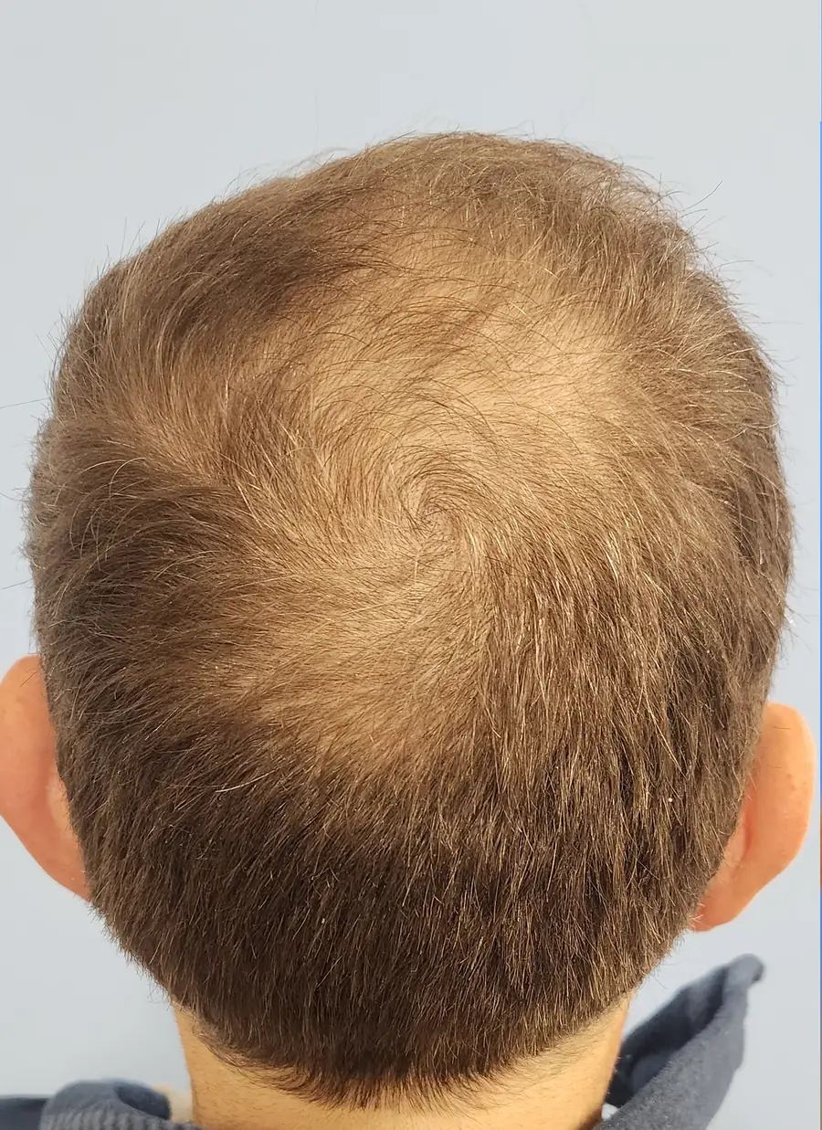 Before hair transplant — 4,142 grafts · 59 y/o man