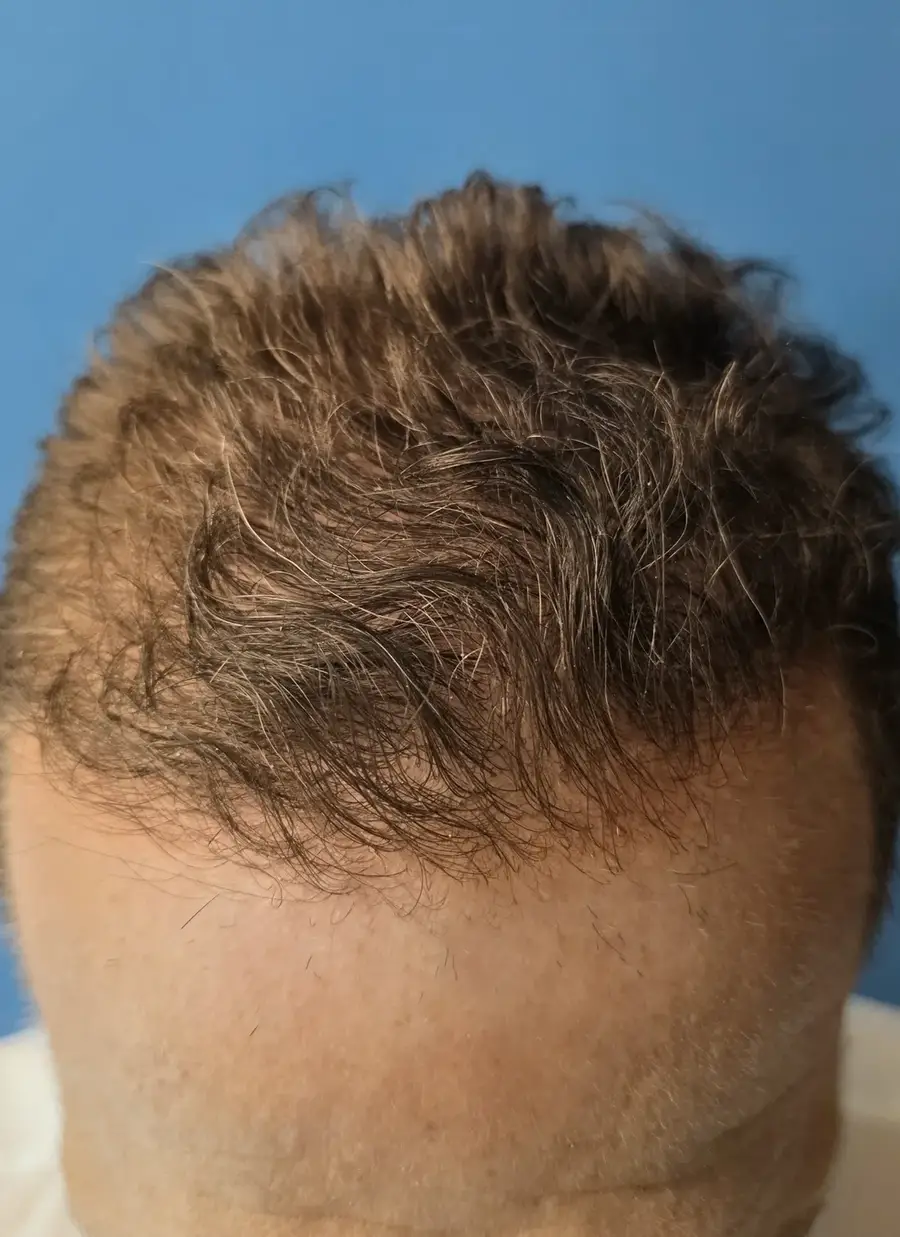 After ARTAS iXi Robotic FUE + NeoGraft, 4,142 grafts