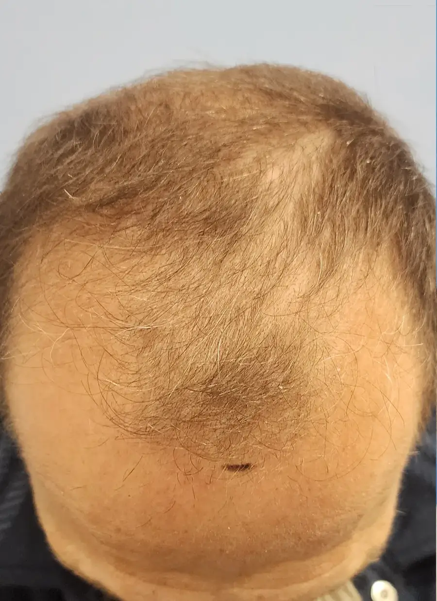 Before ARTAS iXi Robotic FUE + NeoGraft, 4,142 grafts