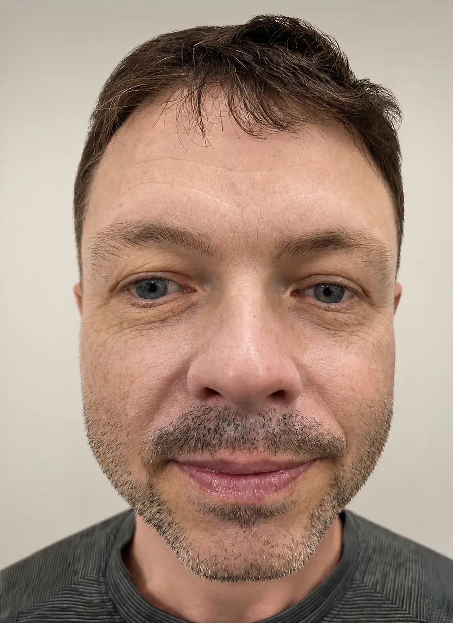 After FUE — lip trauma repair, 275 grafts