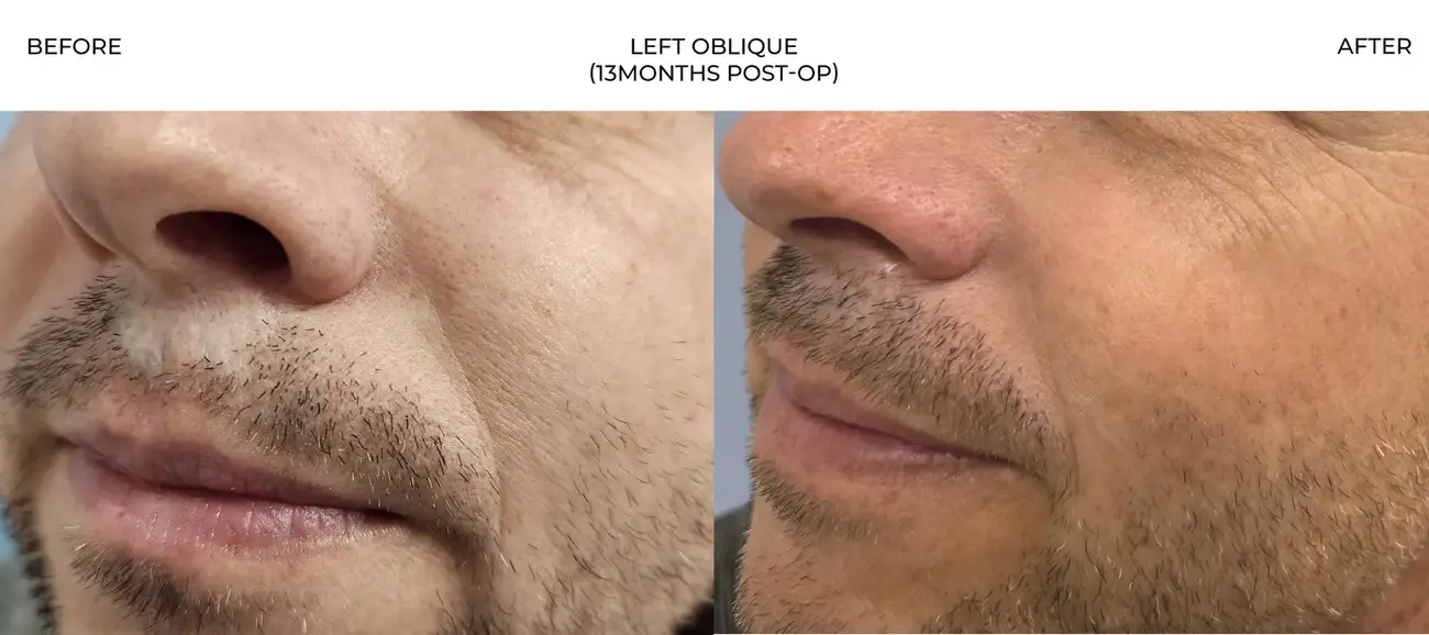 Left oblique view before and after FUE Traumatic Lip Repair, 275 grafts, 44 year old man