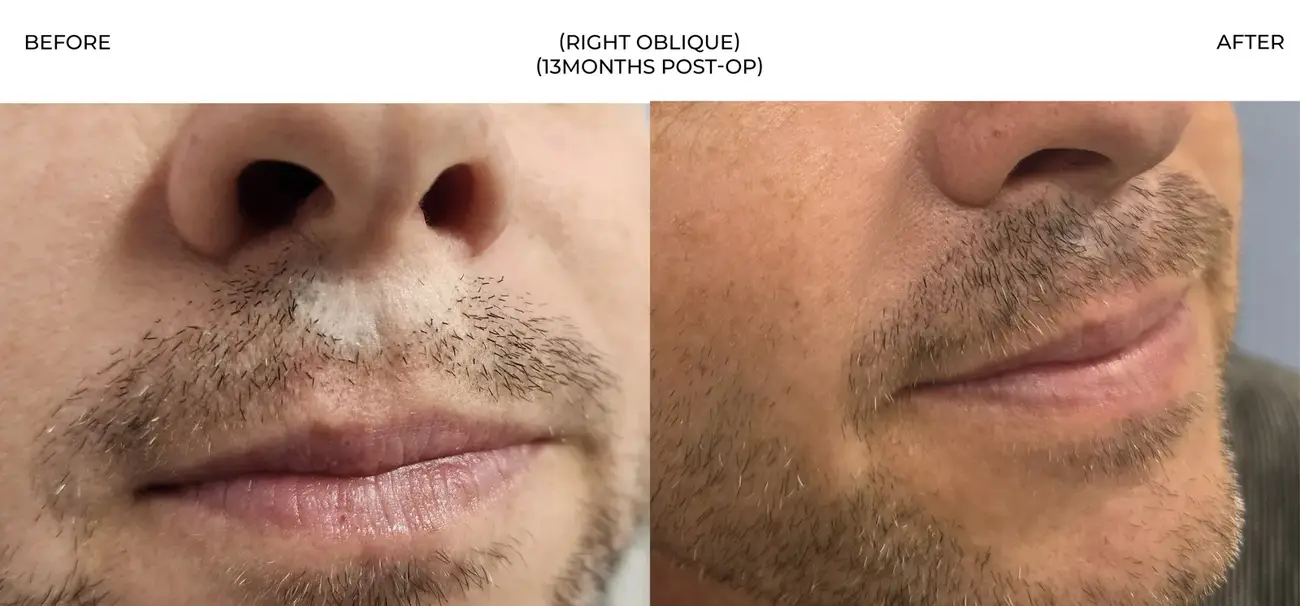 Right oblique view before and after FUE Traumatic Lip Repair, 275 grafts, 44 year old man
