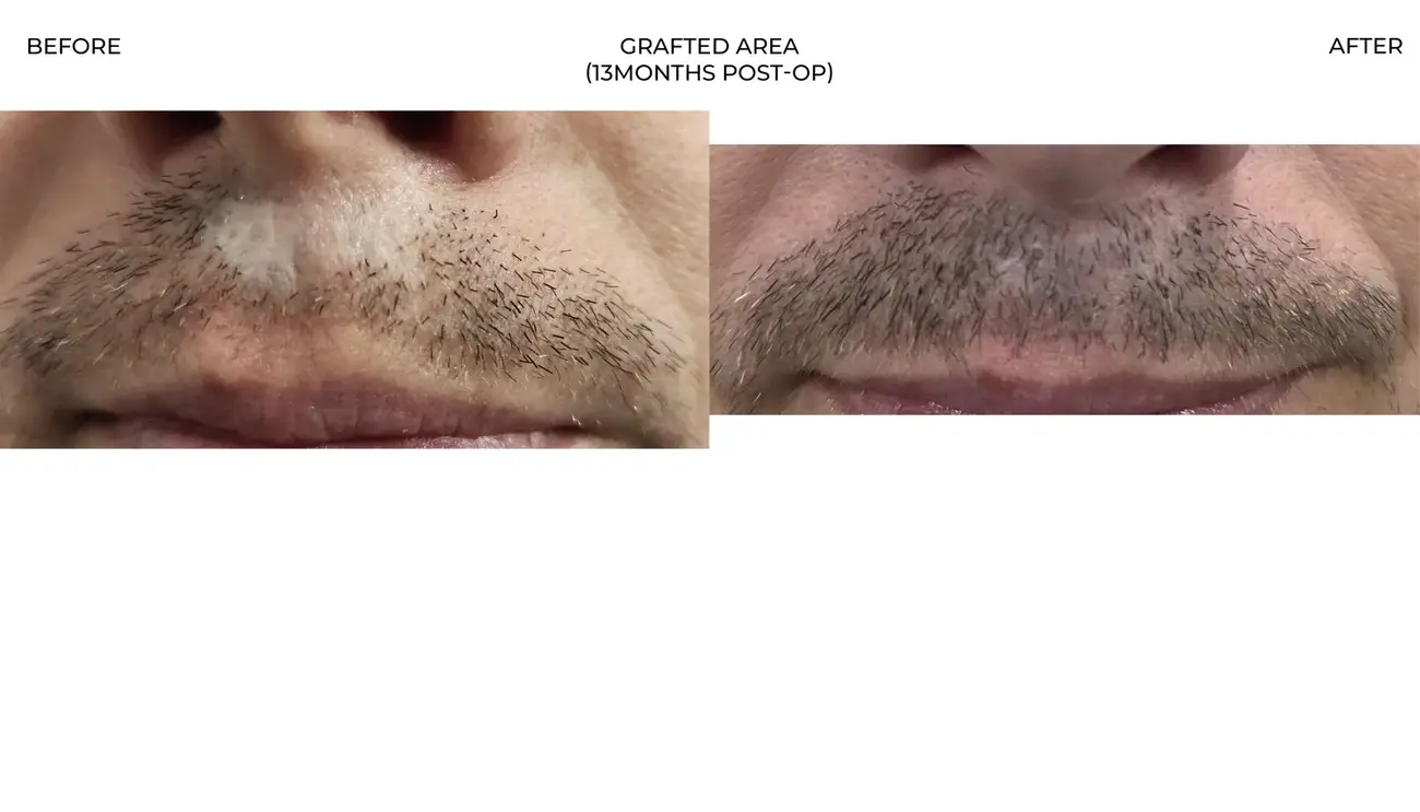 Grafted area view before and after FUE Traumatic Lip Repair, 275 grafts, 44 year old man