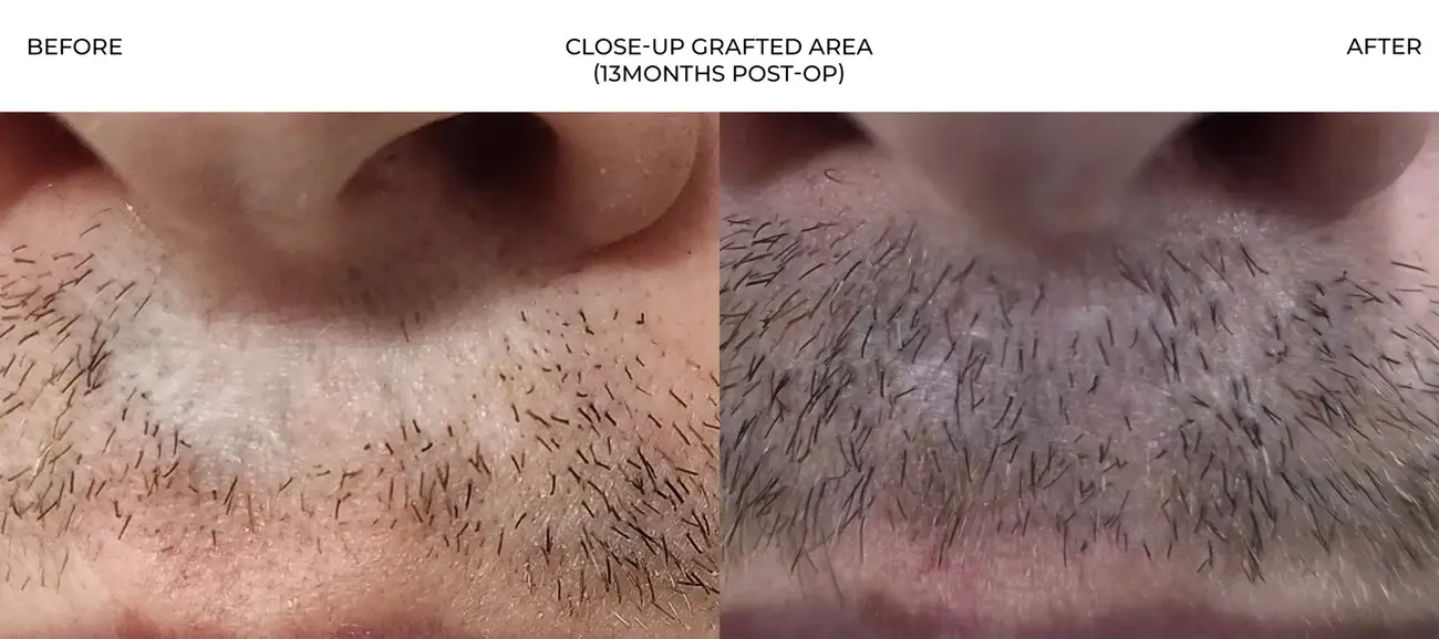 Close-up of grafted area view before and after FUE Traumatic Lip Repair, 275 grafts, 44 year old man