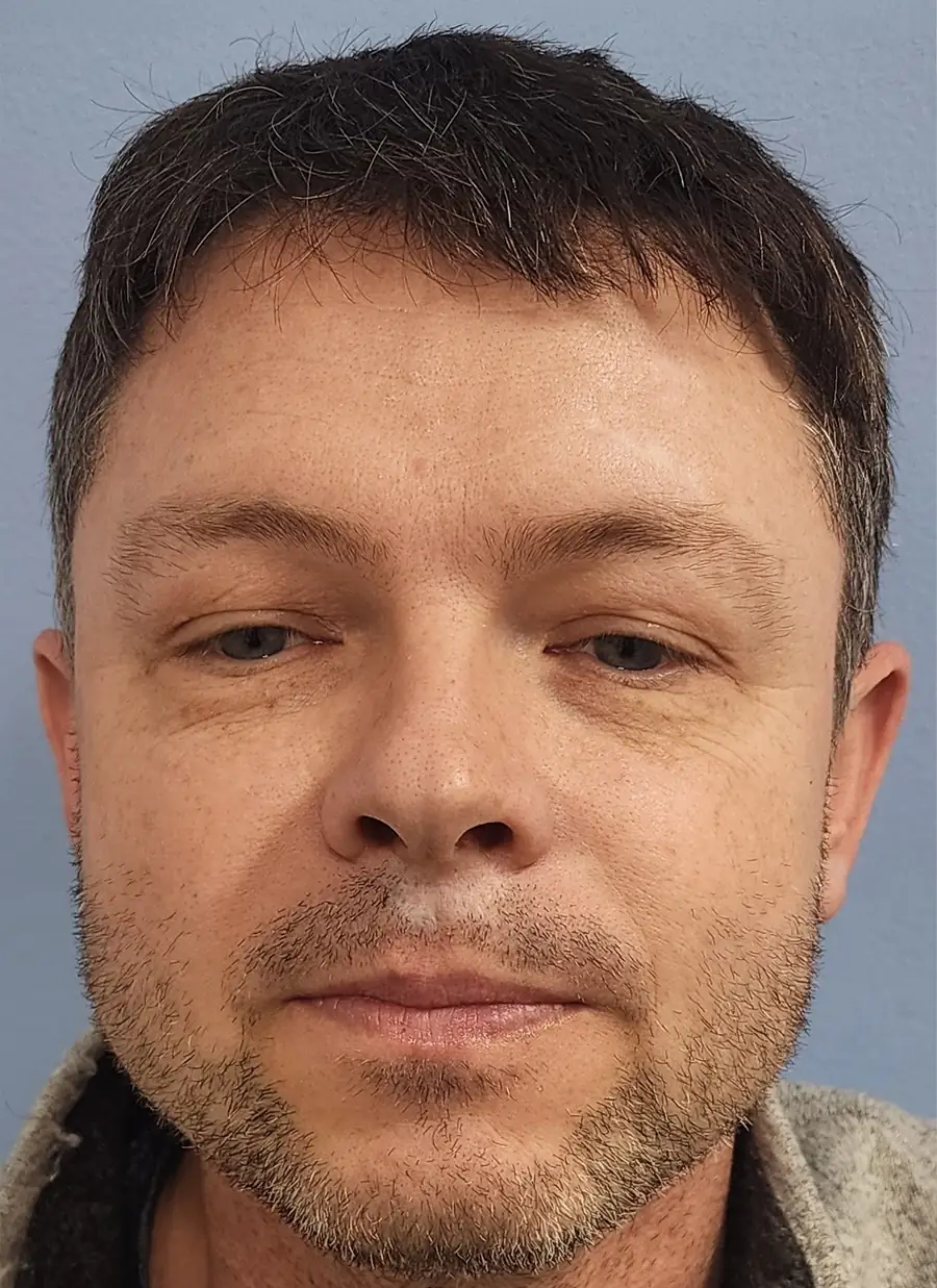 Before FUE — lip trauma repair, 275 grafts