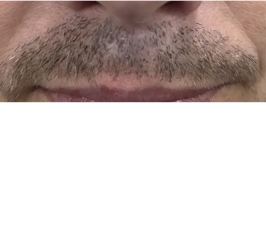 After FUE Traumatic Lip Repair, 275 grafts