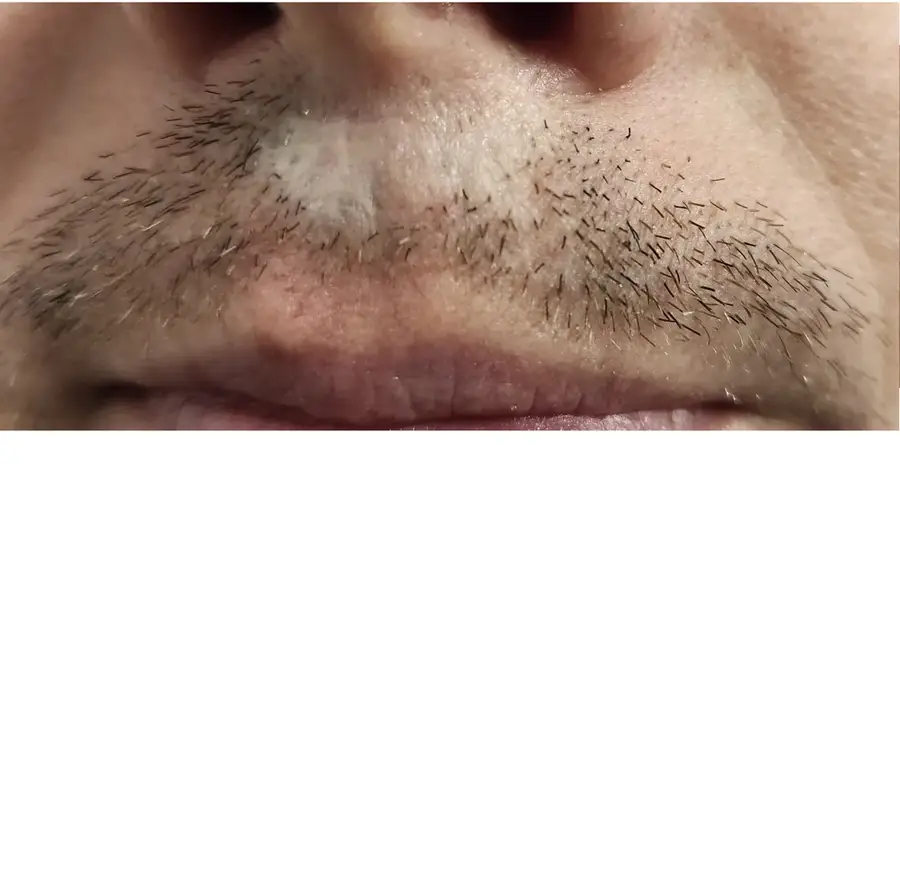Before FUE Traumatic Lip Repair, 275 grafts