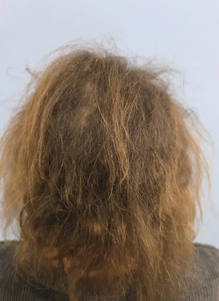 After hair transplant — 3,510 grafts · 73 y/o woman