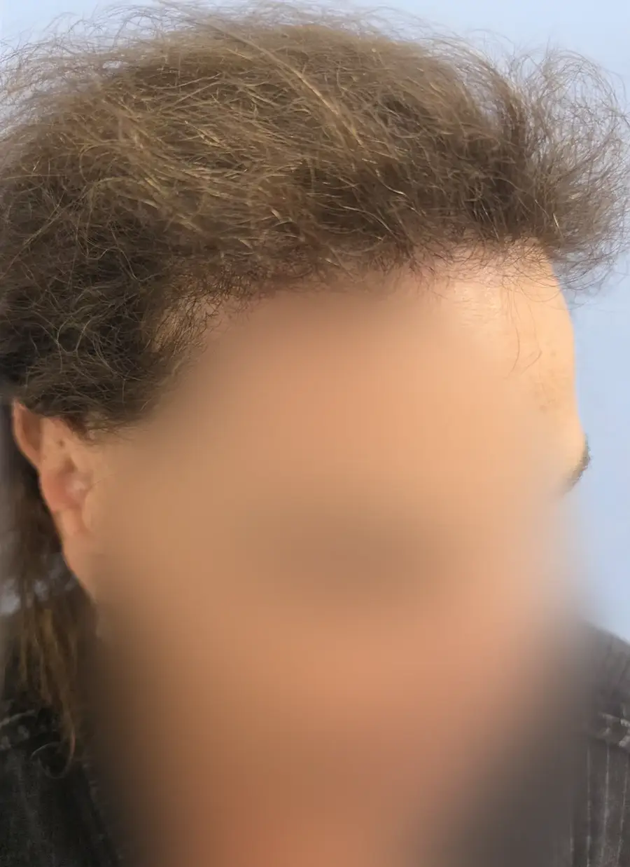 After FUT (strip), 3,510 grafts