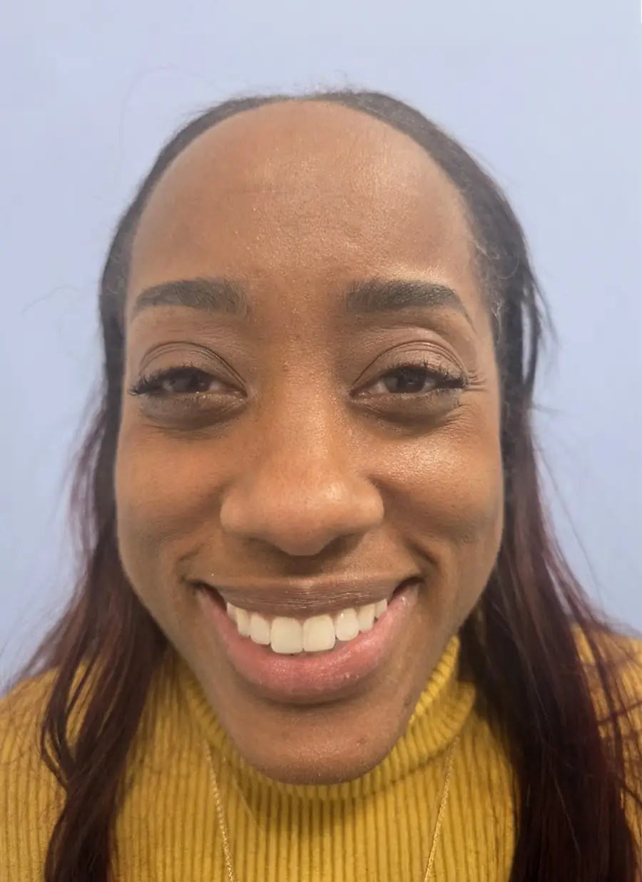 After hair transplant — 2,011 grafts · 40 y/o woman