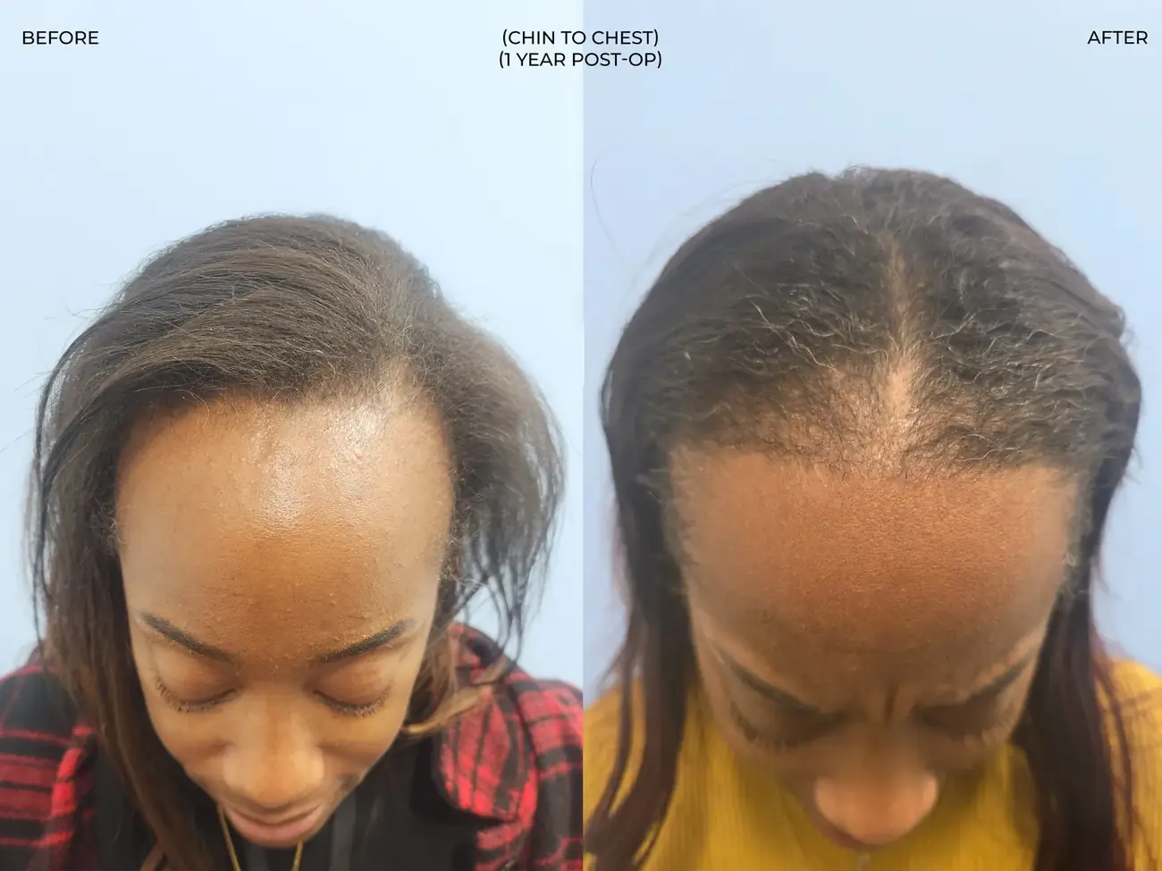 Chin to chest view before and after FUE (NeoGraft), 2,011 grafts, 40 year old woman