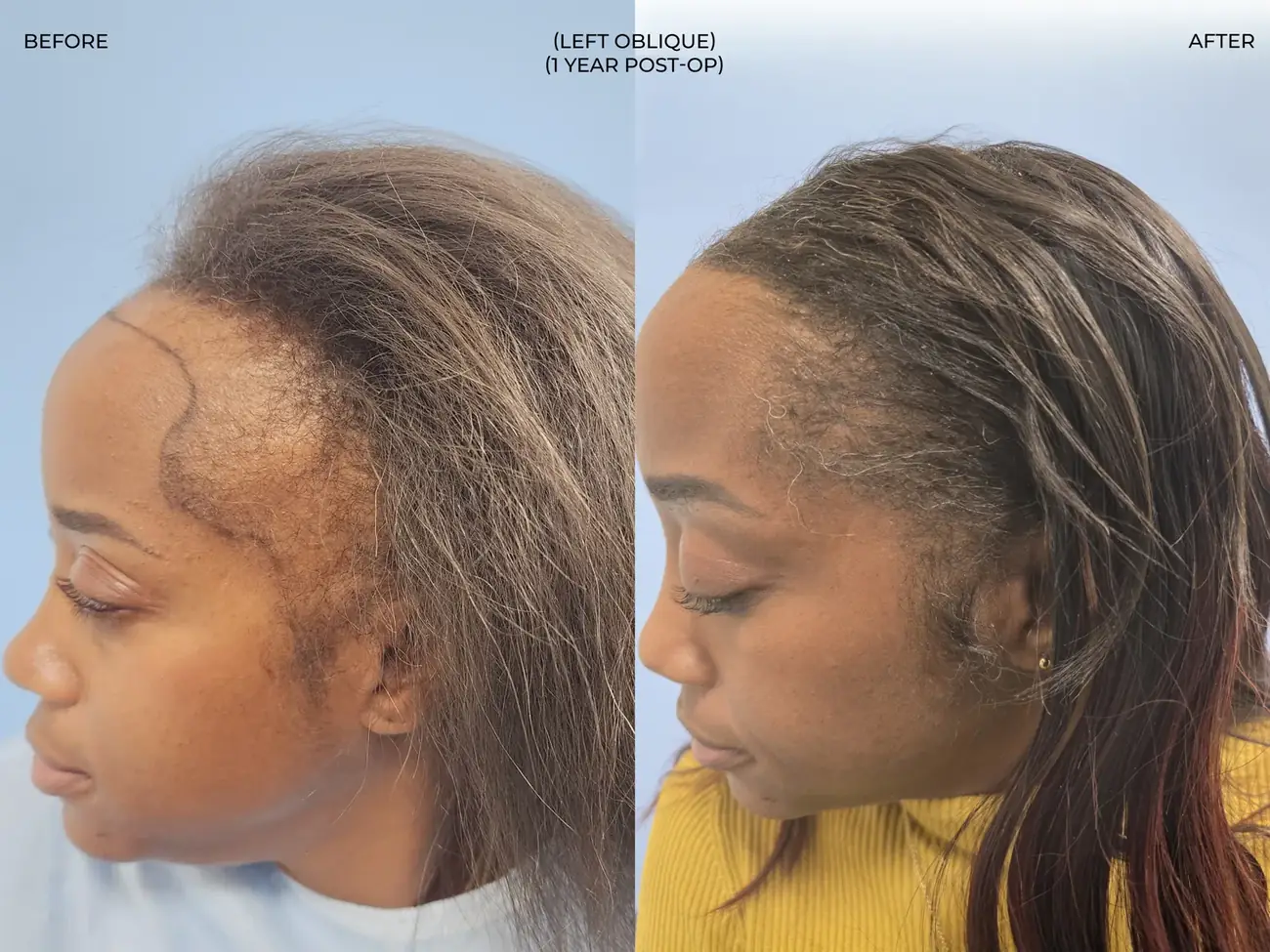 Left oblique view before and after FUE (NeoGraft), 2,011 grafts, 40 year old woman