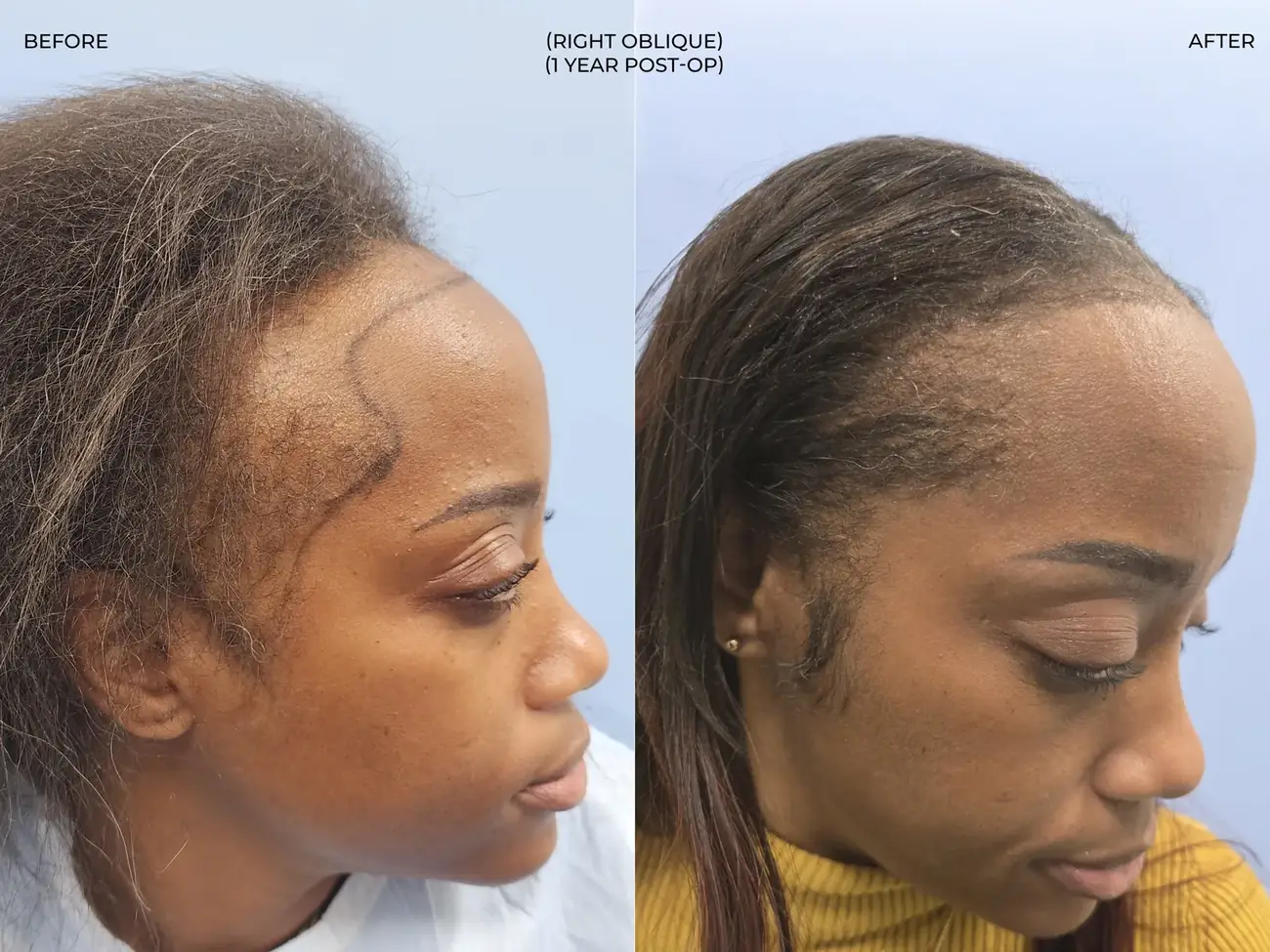 Right oblique view before and after FUE (NeoGraft), 2,011 grafts, 40 year old woman