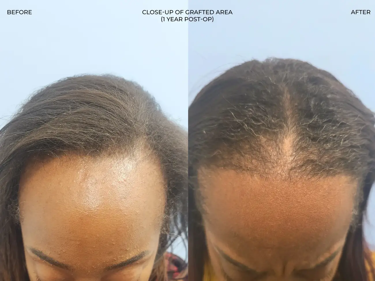 Top-down view before and after FUE (NeoGraft), 2,011 grafts, 40 year old woman