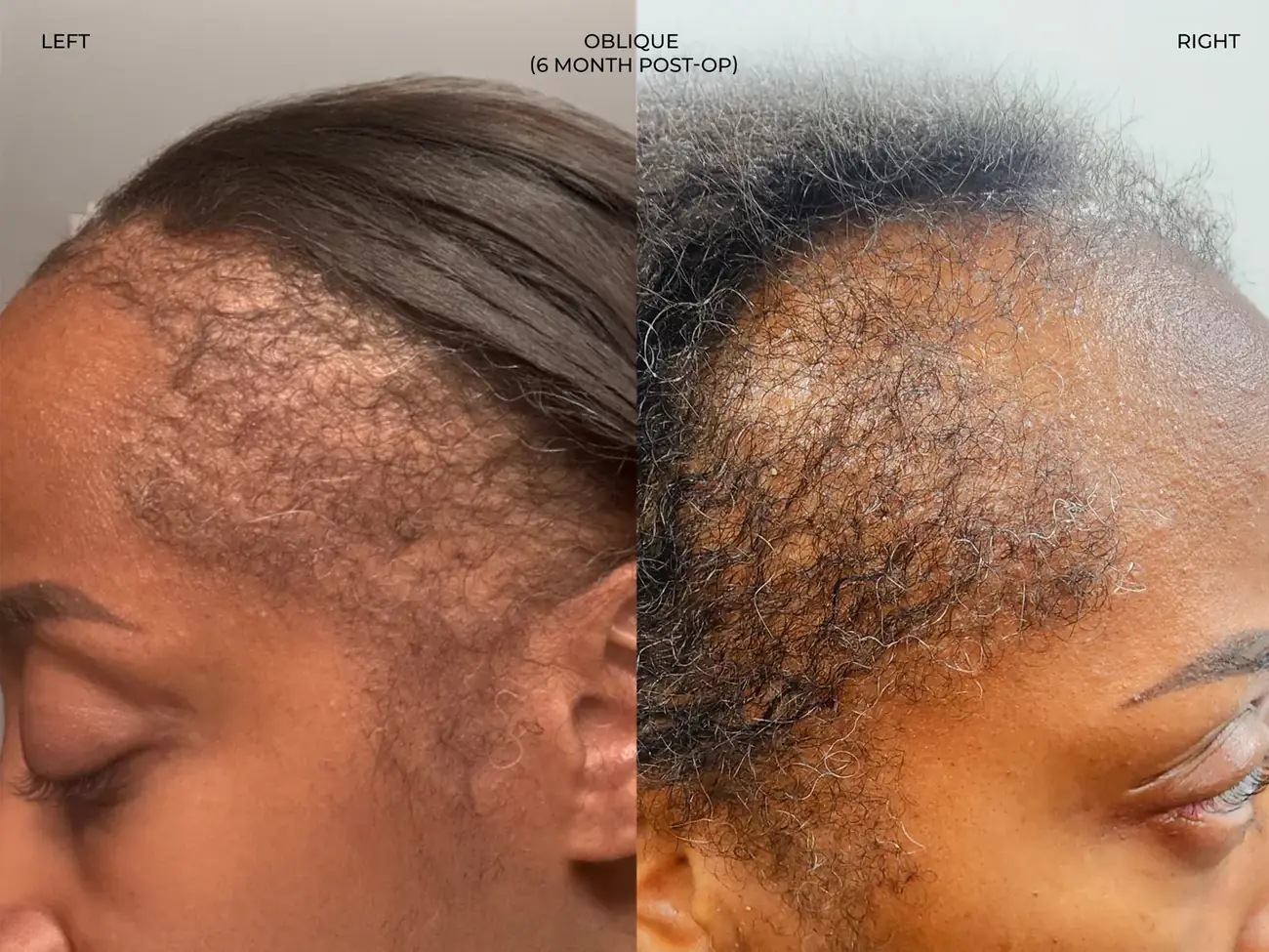 Donor area view before and after FUE (NeoGraft), 2,011 grafts, 40 year old woman