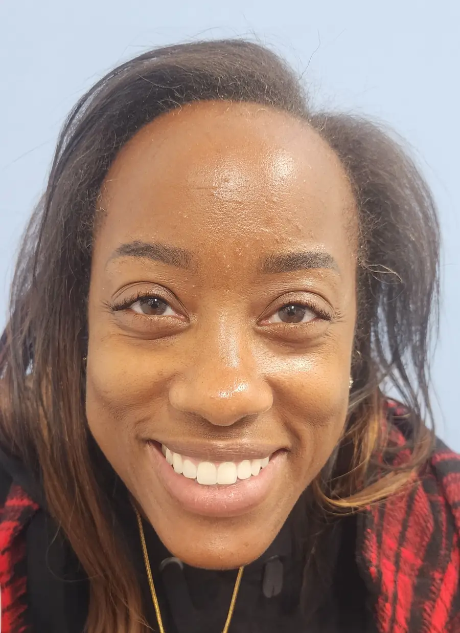 Before hair transplant — 2,011 grafts · 40 y/o woman