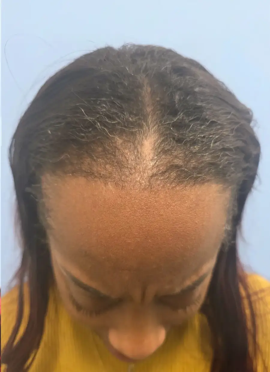 After NeoGraft Manual FUE, 2,011 grafts