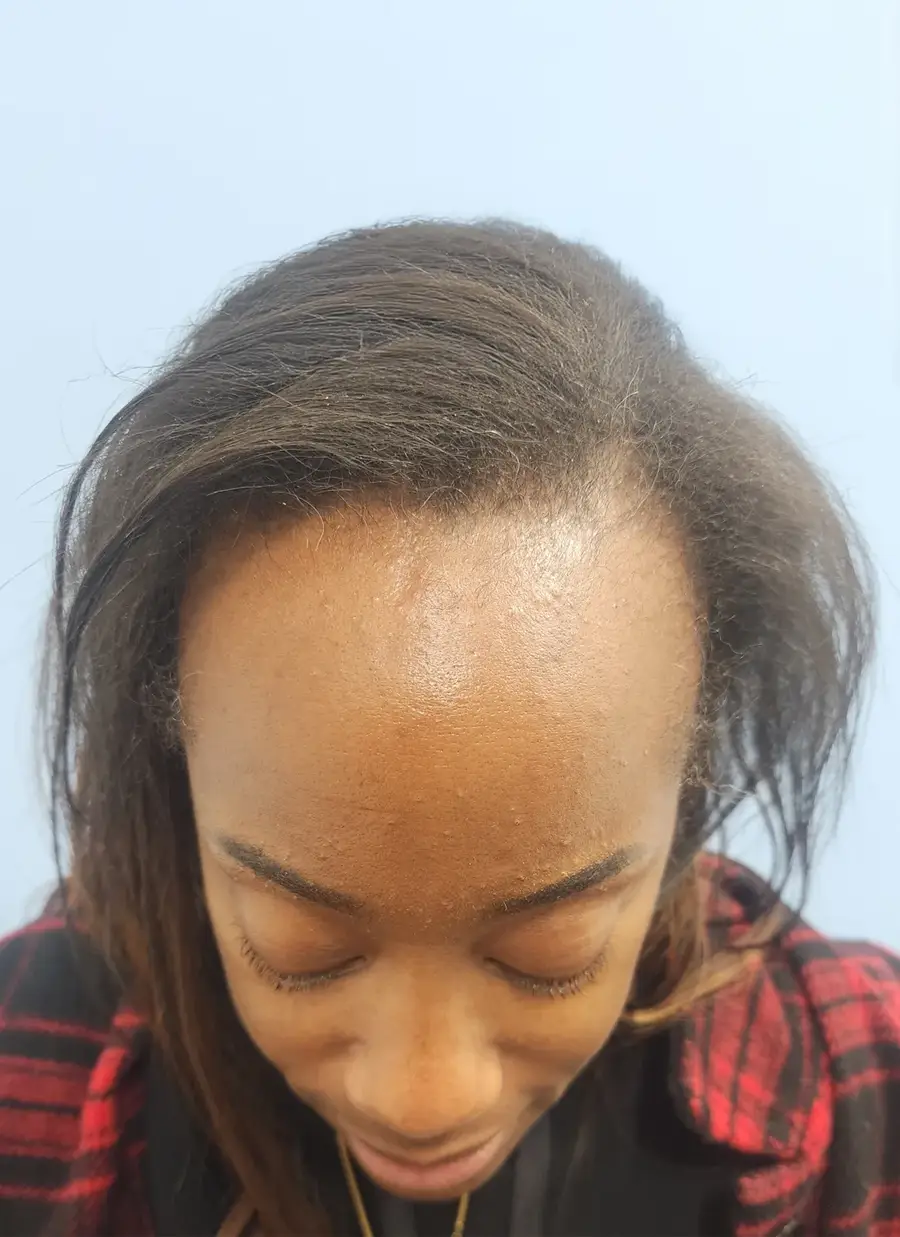 Before NeoGraft Manual FUE, 2,011 grafts