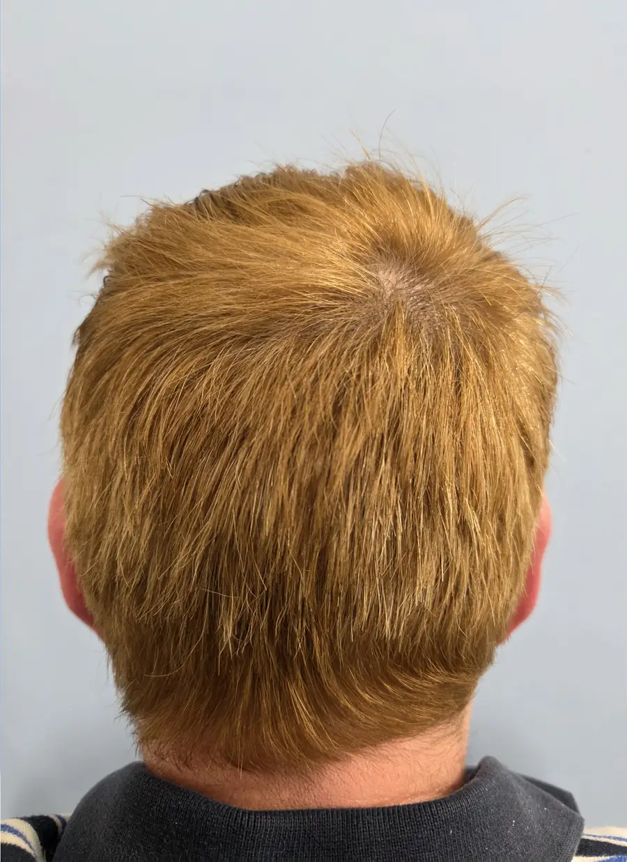 After FUT (strip), 3,300 grafts
