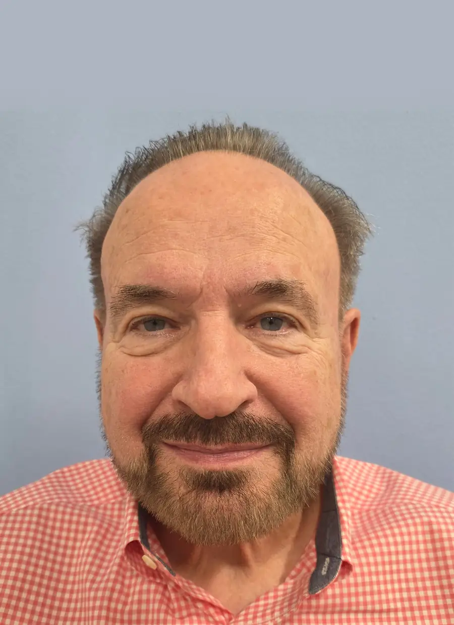 After FUE (NeoGraft), 2,752 grafts
