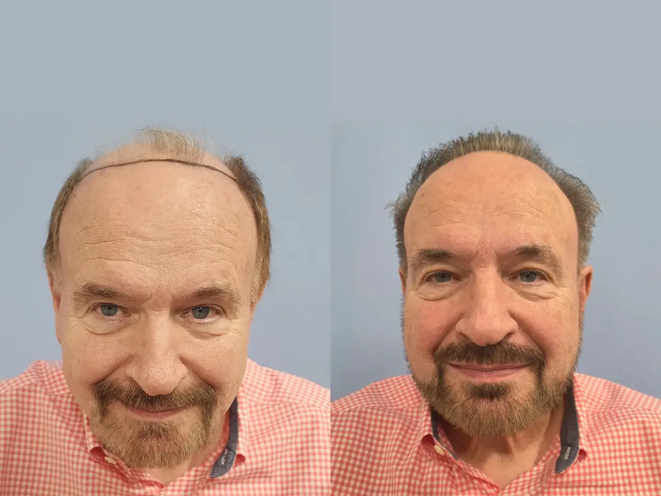Front facial view before and after FUE (NeoGraft), 2,752 grafts, 74 year old man