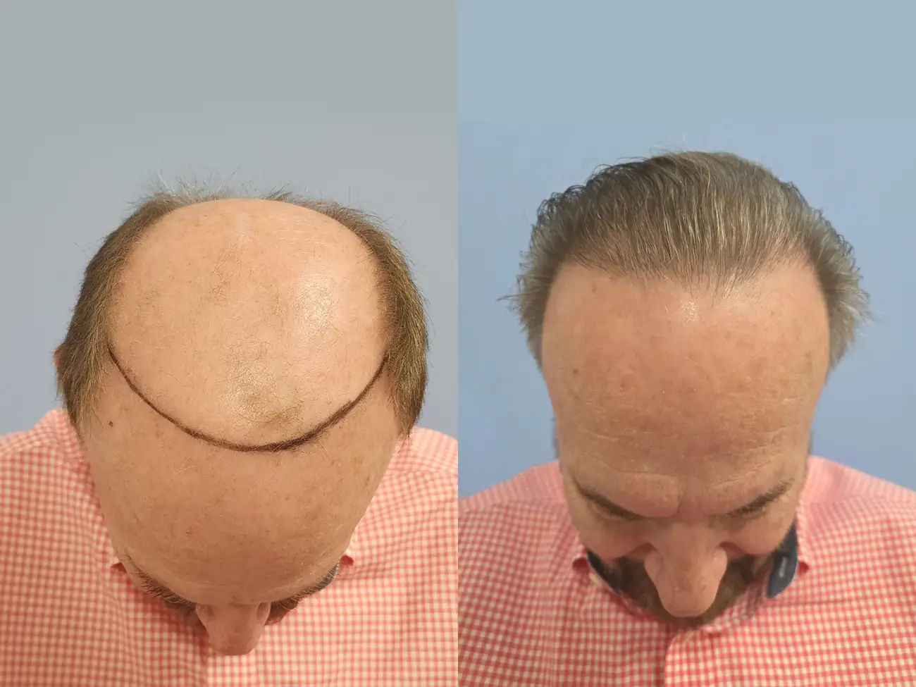Chin to chest view before and after FUE (NeoGraft), 2,752 grafts, 74 year old man