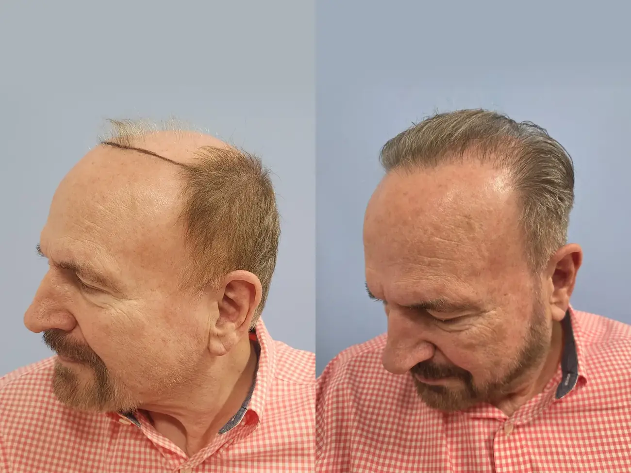 Left oblique view before and after FUE (NeoGraft), 2,752 grafts, 74 year old man