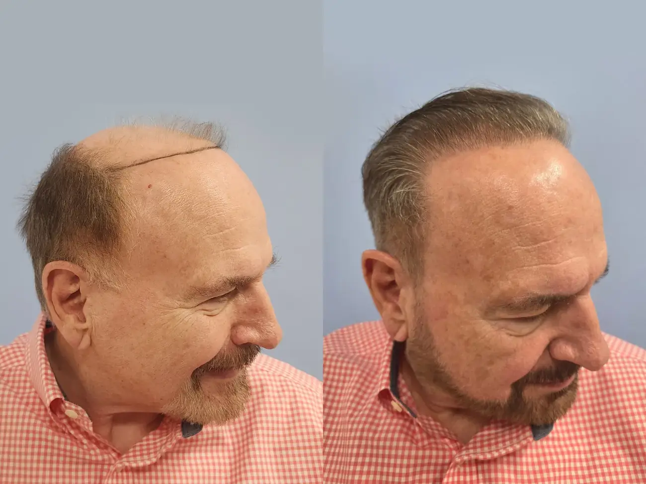 Right oblique view before and after FUE (NeoGraft), 2,752 grafts, 74 year old man