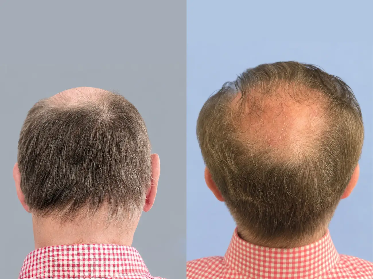 Vertex (crown) view before and after FUE (NeoGraft), 2,752 grafts, 74 year old man