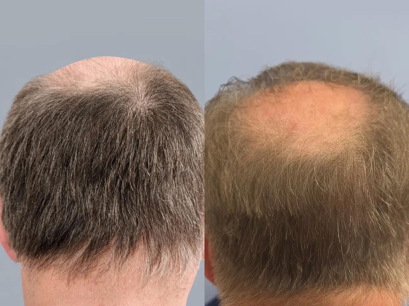Donor area view before and after FUE (NeoGraft), 2,752 grafts, 74 year old man