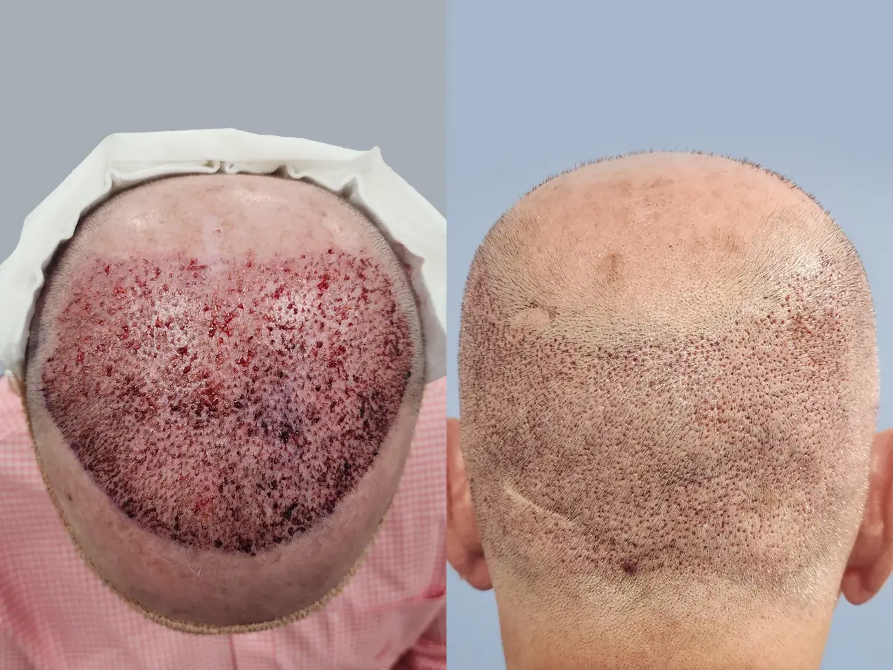 Hairline close-up view before and after FUE (NeoGraft), 2,752 grafts, 74 year old man